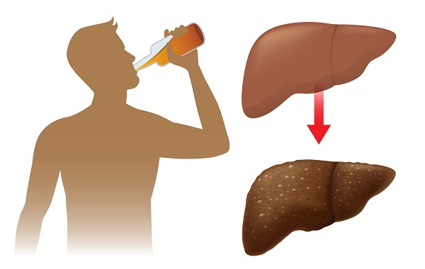 Tìm hiểu những biến chứng của viêm gan do rượu