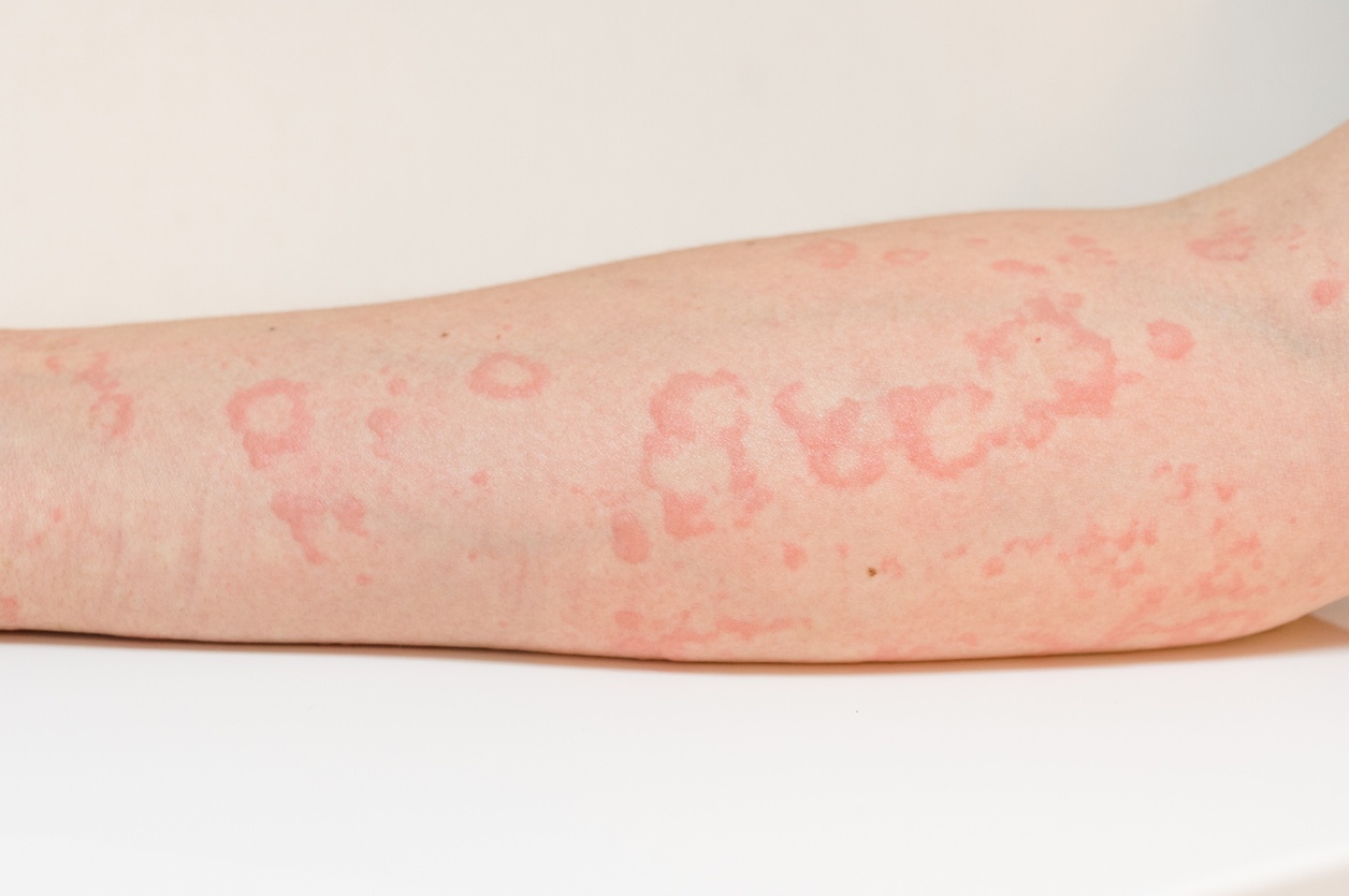 Triệu chứng điển hình của bệnh mề đay là các vết ban trên da
