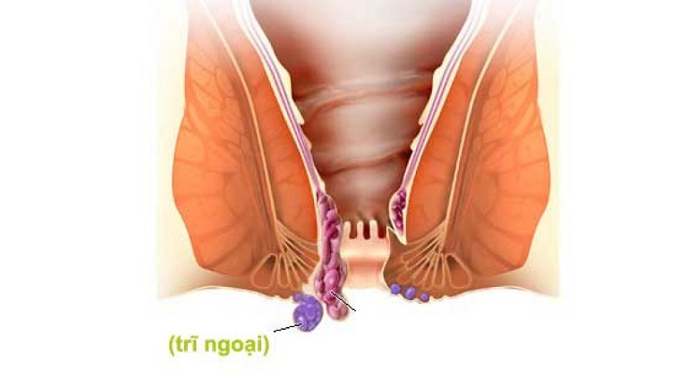 Tuýp gel bôi trĩ chỉ nên sử dụng cho trĩ độ nhẹ và trĩ ngoại