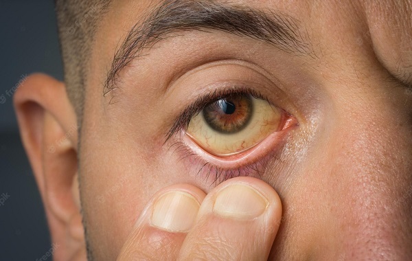 Vàng mắt là một dấu hiệu của viêm gan A