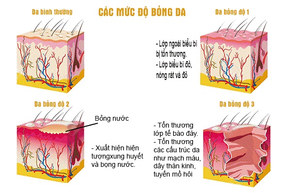 vết bỏng bị phồng