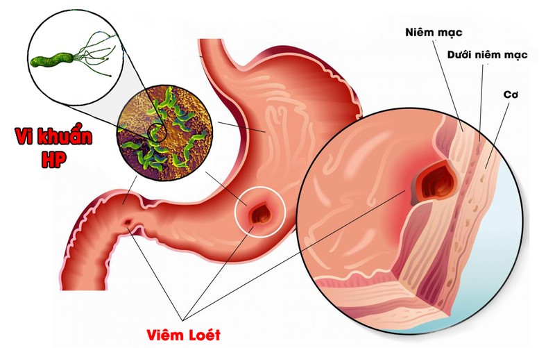 viêm dạ dày hp dương tính