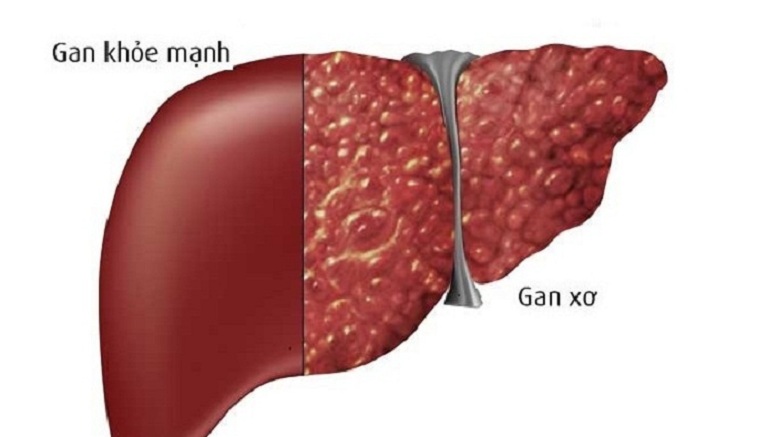 Viêm gan B có chữa khỏi được không