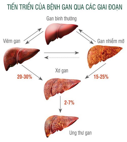 Viêm gan B mạn tính 