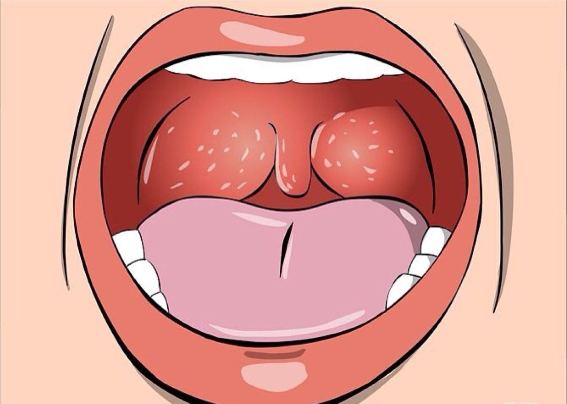 Viêm họng hạt khá phổ biến và gây nhiều khó khăn trong sinh hoạt