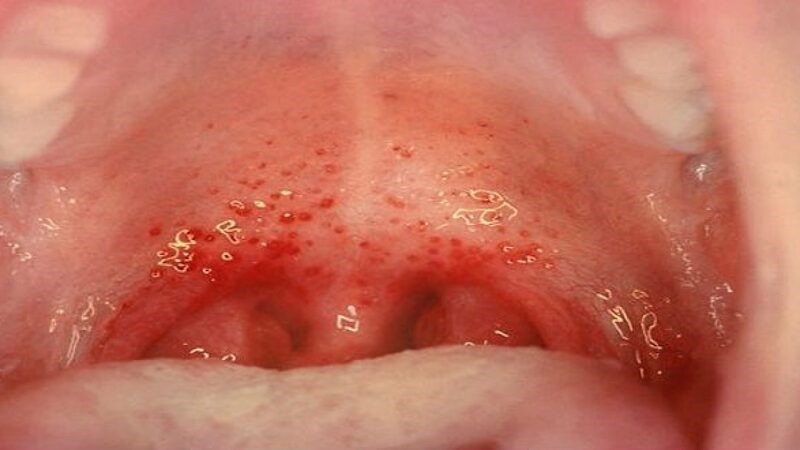 Viêm họng liên cầu khuẩn gây đau họng và hôi miệng