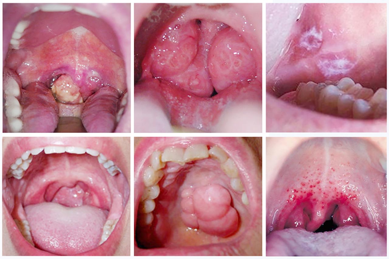 Viêm họng mãn tính do hút thuốc lá có nhiều triệu chứng