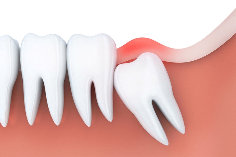 viêm lợi răng hàm