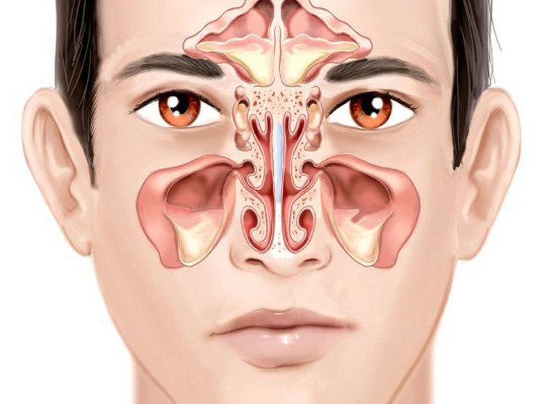 Viêm xoang là bệnh lý gây ngạt mũi phổ biến