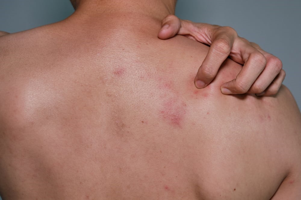 Vùng da bị giời leo thường có cảm giác đau hoặc ngứa ran trước khi phát ban