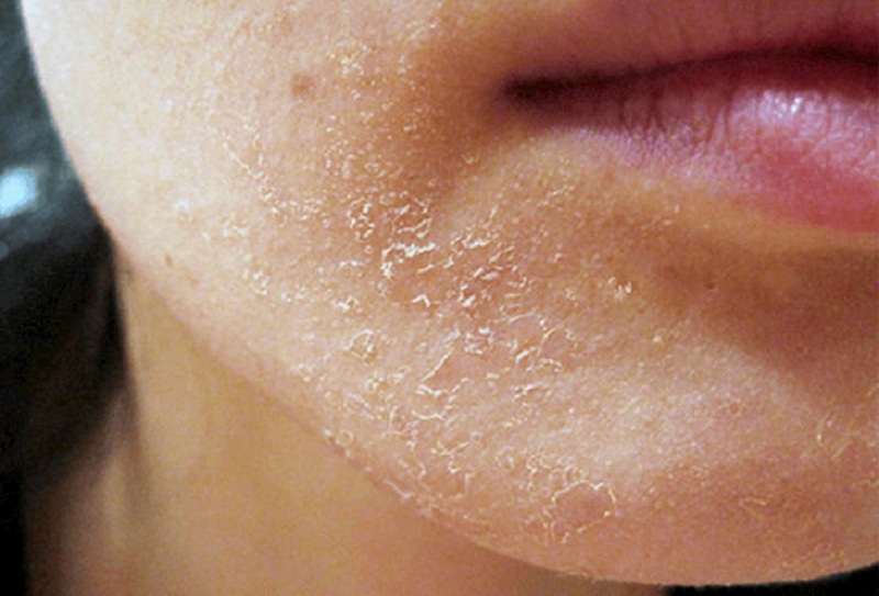 Vùng da quanh môi và khóe miệng rất dễ bị bong tróc vào mùa đông