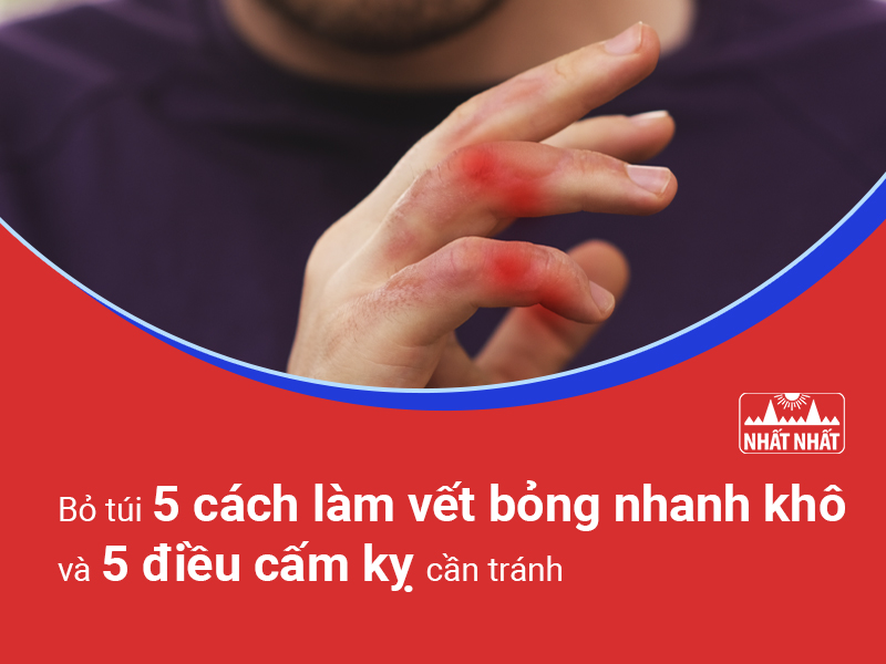 cách làm vết bỏng nhanh khô