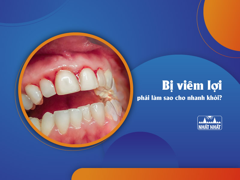 bị viêm lợi phải làm sao