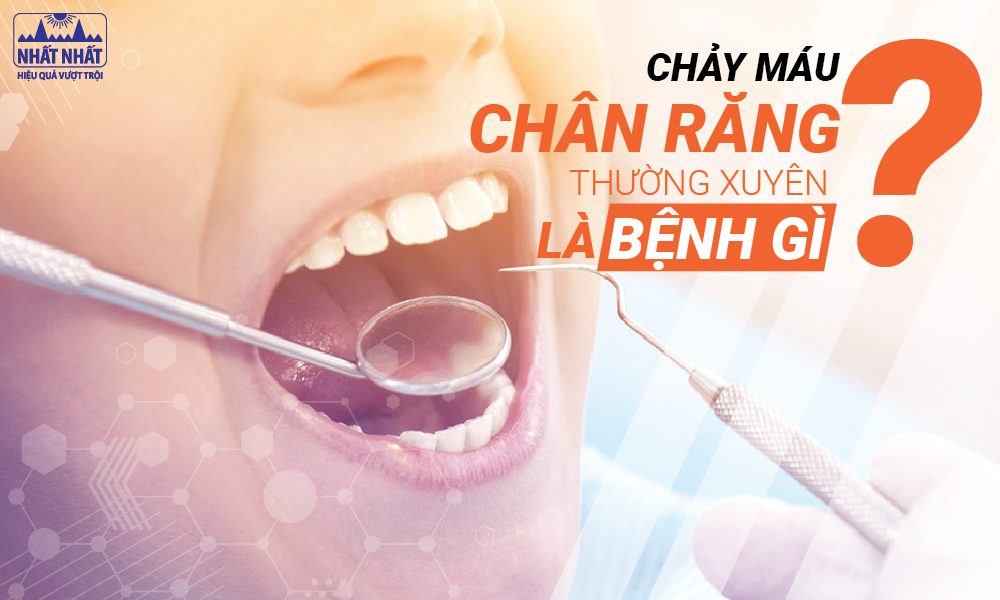 Chảy máu chân răng thường xuyên là bệnh gì?