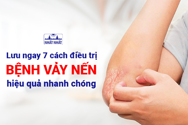 Lưu ngay 7 cách điều trị bệnh vảy nến hiệu quả nhanh chóng