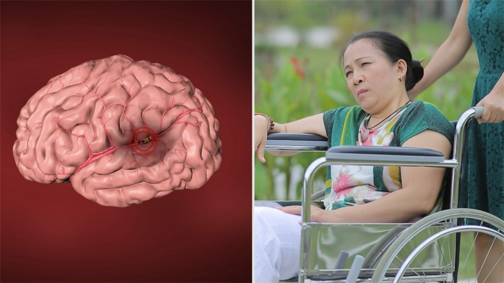 Đặc trị liệt, mắt xếch, méo miệng sau tai biến mạch não bằng thuốc Đông y thế hệ 2