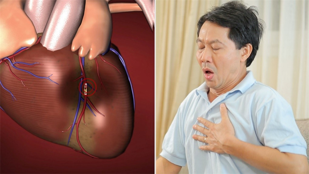 Phòng ngừa và điều trị bệnh mạch vành gây tử vong sau vài phút bằng thuốc Đông y thế hệ 2