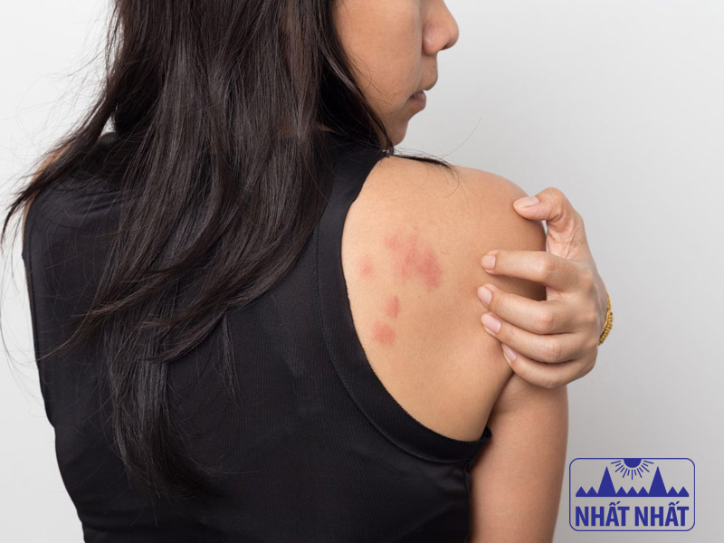Bật mí các phương pháp điều trị mề đay mãn tính hiệu quả