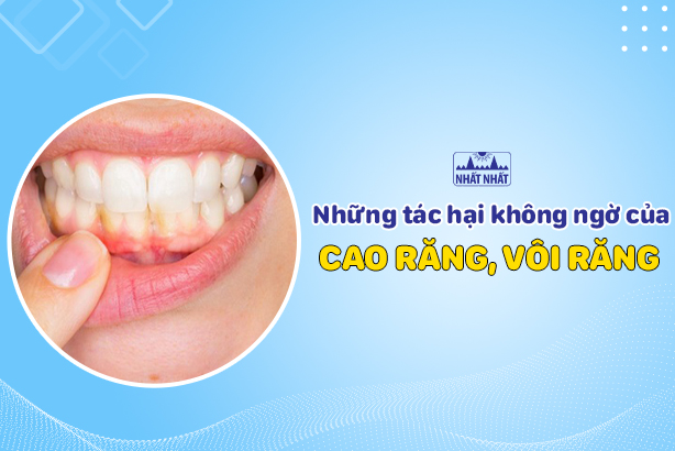 Những tác hại không ngờ của cao răng, vôi răng