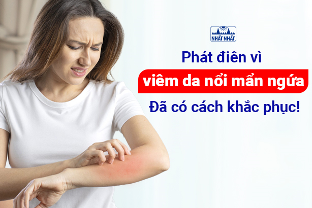 Phát điên vì viêm da nổi mẩn ngứa: đã có cách khắc phục!