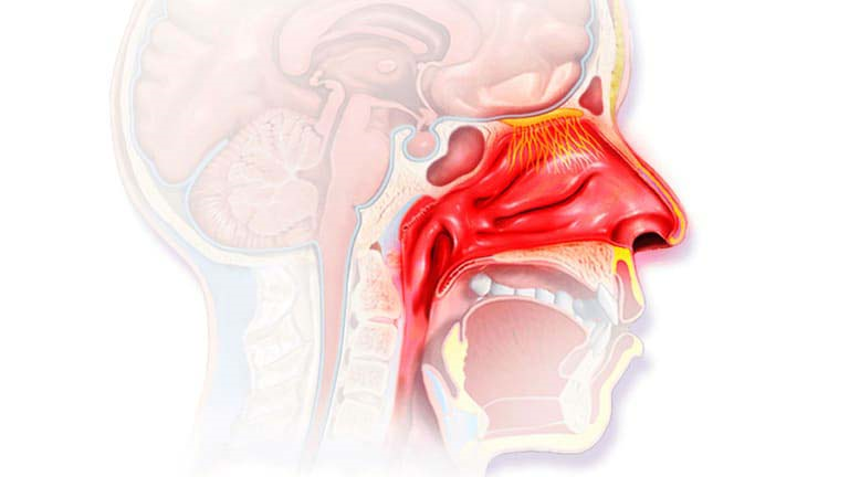 Viêm mũi phù nề: Nguyên nhân và các biện pháp điều trị