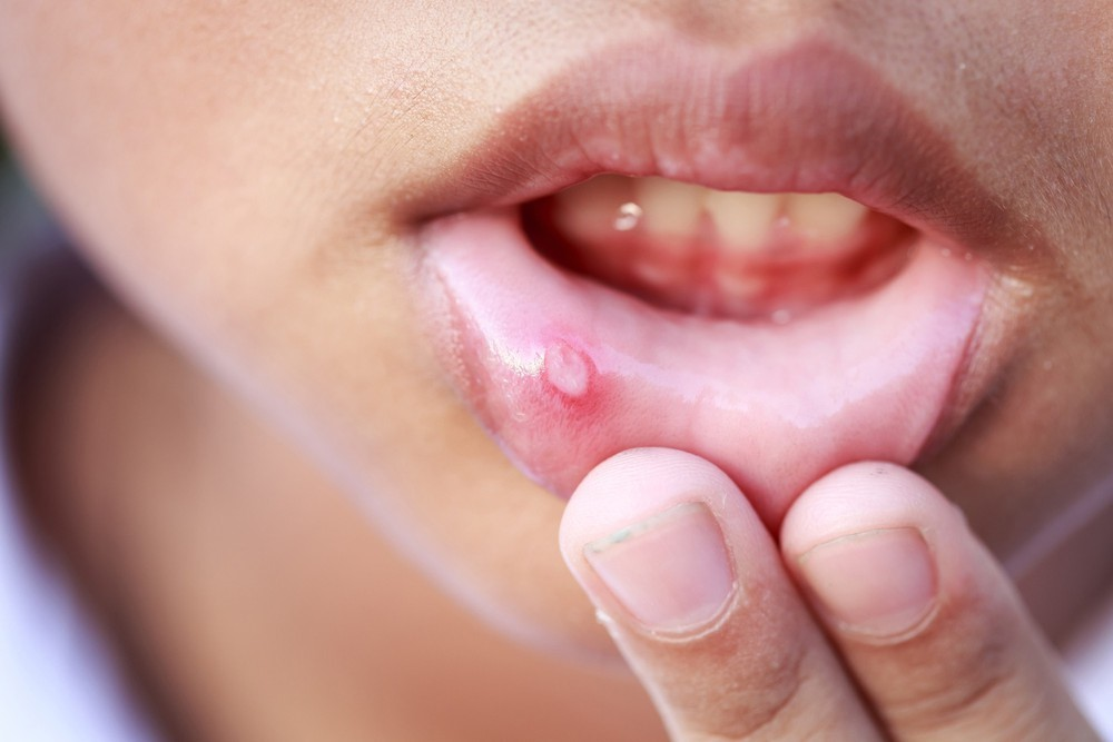 Xử lý nhanh nhiệt miệng ở trẻ em