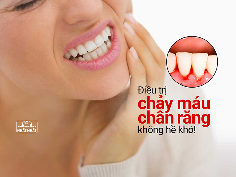 Điều trị chảy máu chân răng không hề khó!