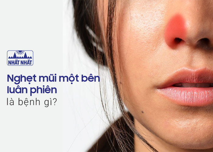Nghẹt mũi một bên luân phiên là bệnh gì?