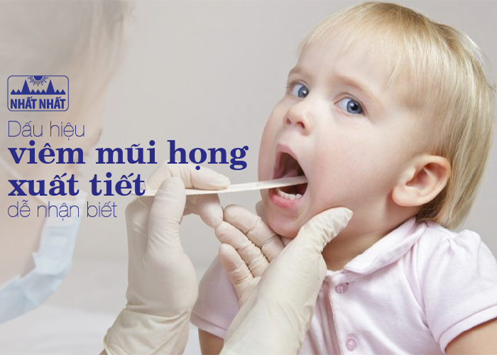 Dấu hiệu viêm mũi họng xuất tiết dễ nhận biết và cách điều trị hiệu quả