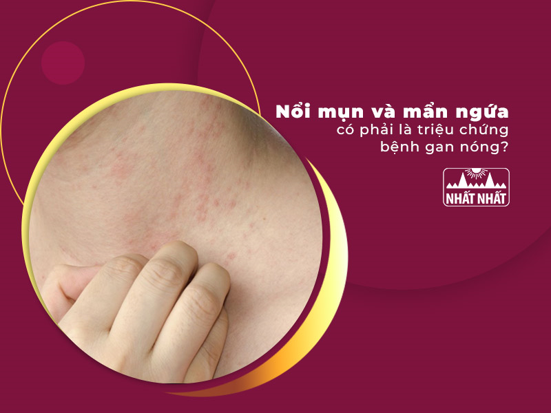 Nổi mụn và mẩn ngứa có phải là triệu chứng bệnh gan nóng?