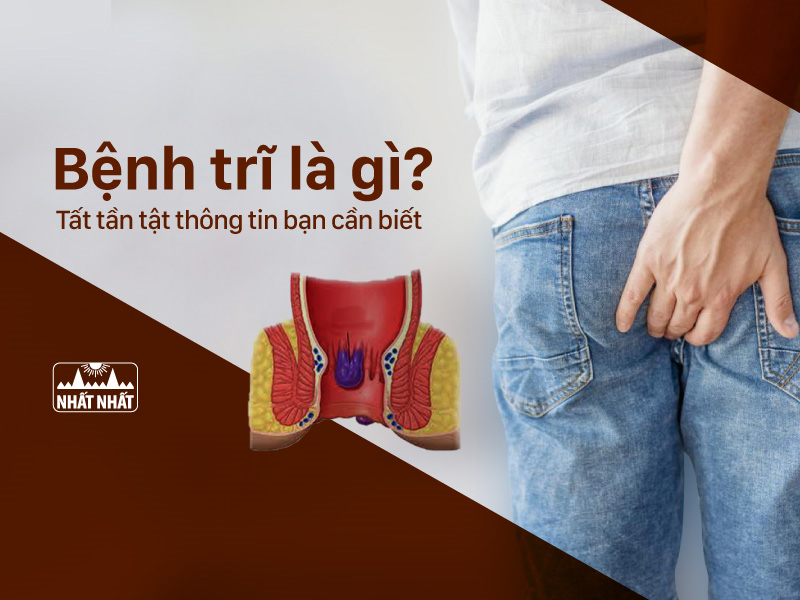 Bệnh trĩ là gì? Tất tần tật thông tin bạn cần biết