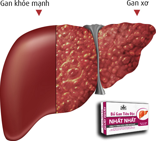 "Sát thủ" hại gan 90% đàn ông Việt mắc phải nhưng rất coi thường