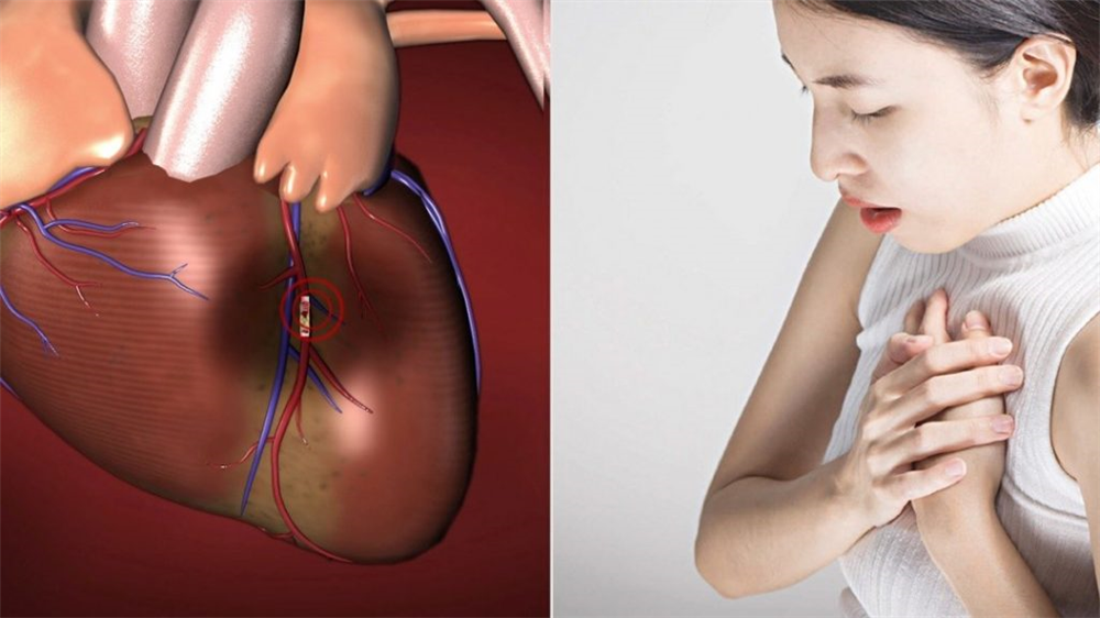 Phòng ngừa nhồi máu cơ tim ở phụ nữ sau mãn kinh bằng thuốc Đông y thế hệ 2