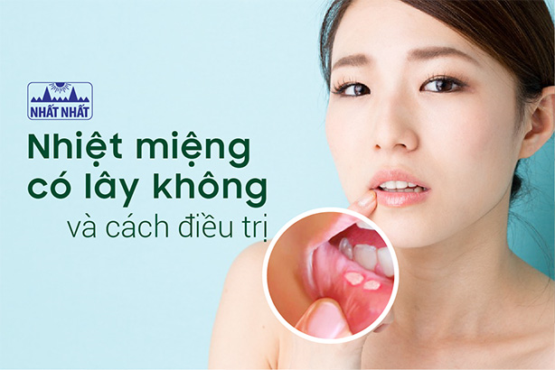 Nhiệt miệng có lây không và cách nào giúp vết loét nhanh lành?