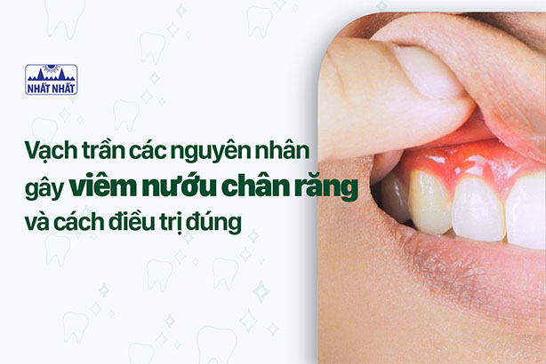 Vạch trần các nguyên nhân gây viêm nướu chân răng và cách điều trị đúng