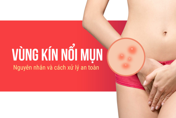 Vùng kín nổi mụn: Nguyên nhân và cách xử lý an toàn