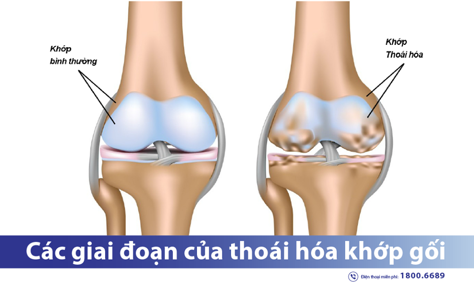 Tìm hiểu 4 giai đoạn của bệnh thoái hóa khớp gối