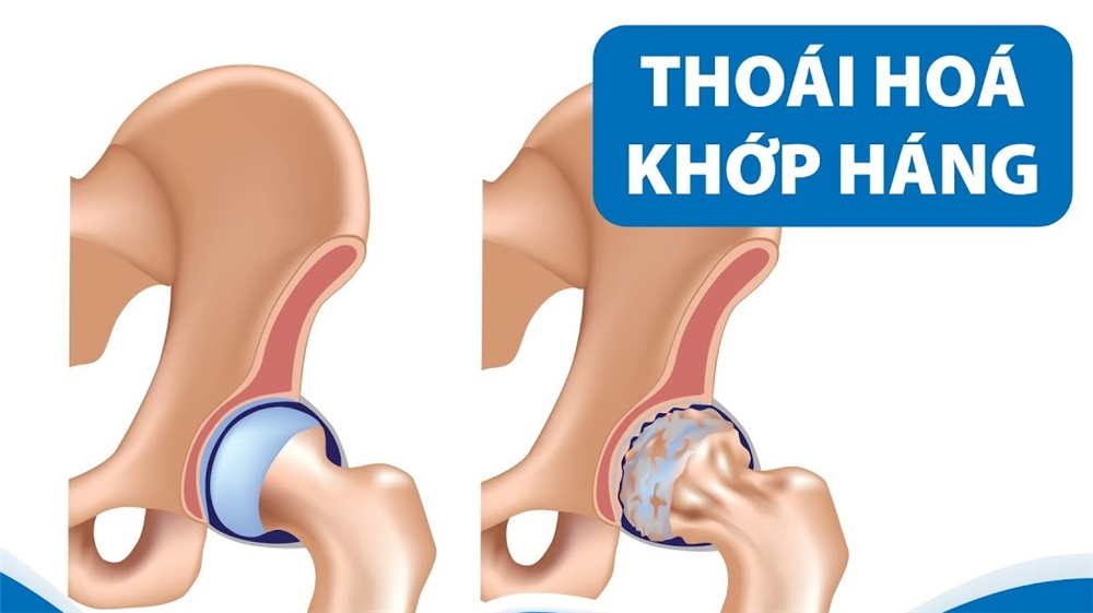 Bệnh thoái hóa khớp háng ở người trẻ: Những thông tin ít người biết