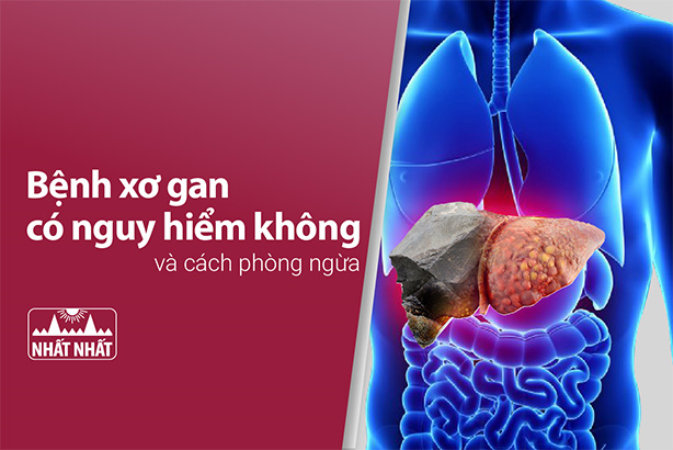 Giải đáp thắc mắc “Bệnh xơ gan có nguy hiểm không và cách phòng ngừa”