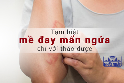 Tạm biệt mề đay mẩn ngứa chỉ với thảo dược đảm bảo hiệu quả
