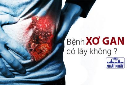 Bệnh xơ gan có lây không? Làm sao để phòng ngừa và điều trị hiệu quả?