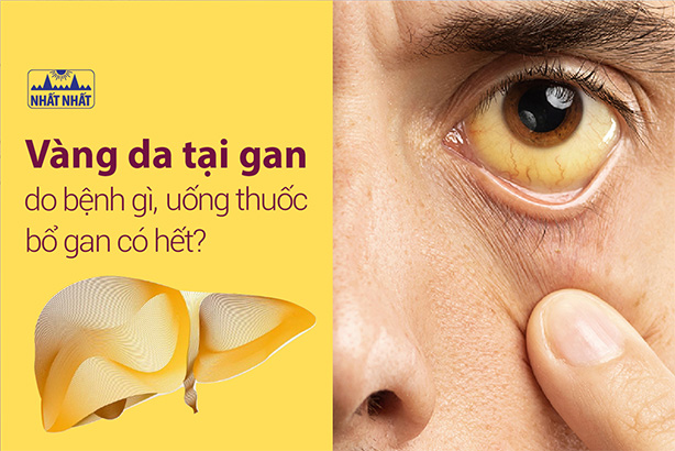 Vàng da tại gan do bệnh gì, uống thuốc bổ gan có hết?