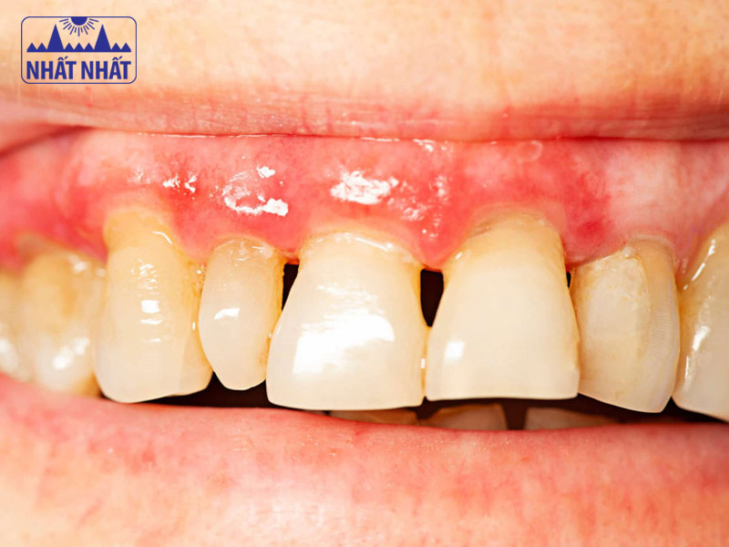 Nhận biết các giải pháp hiệu quả cho người bị viêm chân răng