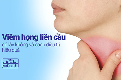 Viêm họng liên cầu có lây không và cách điều trị hiệu quả
