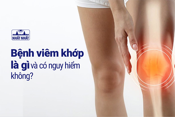 Bệnh viêm khớp là gì và có nguy hiểm không?