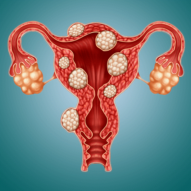 U xơ tử cung có thể xuất hiện ở nhiều vị trí khác nhau