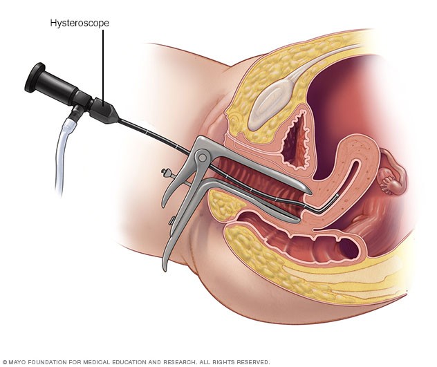 Ảnh: Hysteroscope qua âm đạo và cổ tử cung vào tử cung