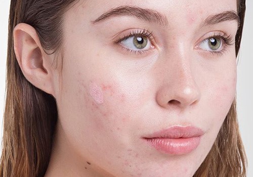 Da nhờn thường đi đôi với da bị mụn