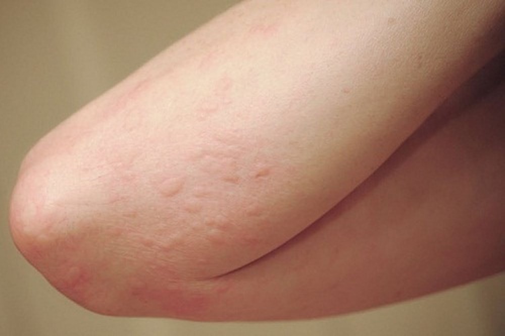 Cần nhận diện mụn nhọt, mẩn ngứa, mề đay do gan nhiễm độc gây ngứa trên da